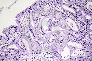 Histopathology of nasal polyps photo