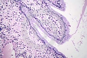 Histopathology of nasal polyps photo
