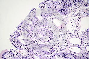 Histopathology of nasal polyps