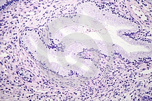 Histopathology of nasal polyps
