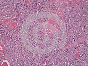 Histopathology ofRound Cell Tumor