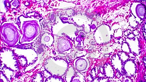 Histopathology of prostate gland hyperplasia