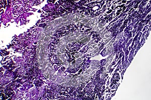 Histopathology of silicosis, light micrograph