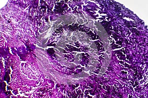 Histopathology of silicosis, light micrograph
