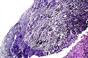 Histopathology of silicosis, light micrograph photo