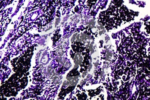 Histopathology of silicosis, light micrograph