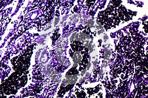 Histopathology of silicosis, light micrograph photo
