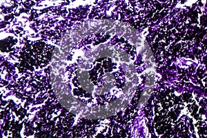 Histopathology of silicosis, light micrograph
