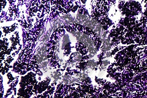 Histopathology of silicosis, light micrograph photo