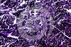 Histopathology of silicosis, light micrograph
