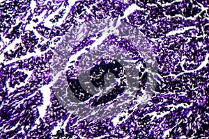 Histopathology of silicosis, light micrograph