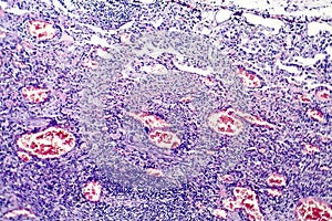 Histopathology of tuberculosis lesion