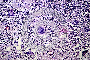 Histopathology of tuberculosis lesion