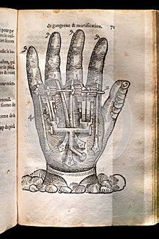 Historical woodcut of an artificial hand