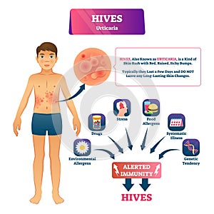Hives urticaria vector illustration. Labeled skin rash explanation scheme. photo