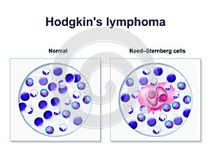 Hodgkin's lymphoma photo