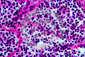 Hodgkin`s lymphoma, light micrograph