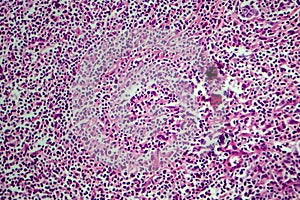 Hodgkin`s lymphoma, light micrograph