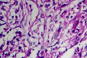 Hodgkin`s lymphoma, light micrograph