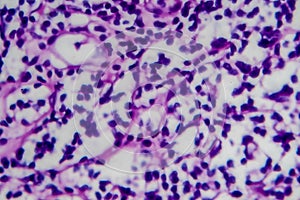 Hodgkin`s lymphoma, light micrograph