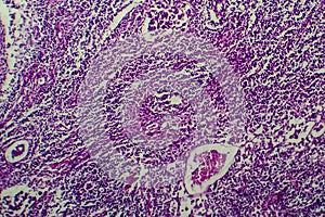 Hodgkin`s lymphoma, light micrograph