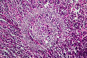 Hodgkin`s lymphoma, light micrograph