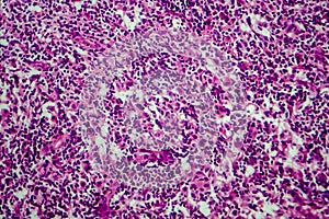 Hodgkin`s lymphoma, light micrograph