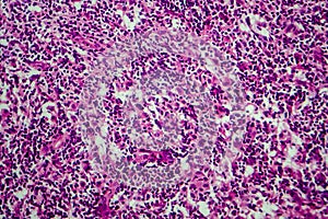 Hodgkin`s lymphoma, light micrograph photo