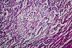 Hodgkin`s lymphoma, light micrograph photo