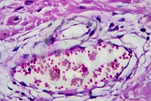 Hodgkin`s lymphoma, light micrograph photo