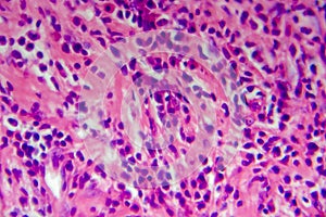 Hodgkin's lymphoma, light micrograph
