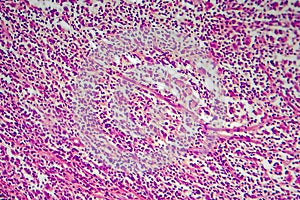 Hodgkin's lymphoma, light micrograph