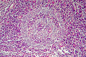 Hodgkin's lymphoma, light micrograph