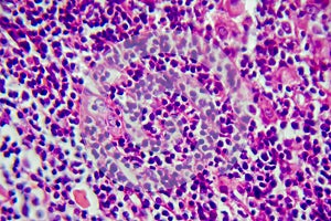 Hodgkin's lymphoma, light micrograph