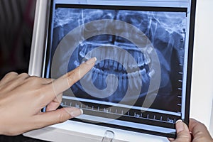 Holding Dental X-Ray