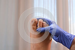 Holding a toe with fungal infection