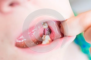 Hole in the gums after dental extraction