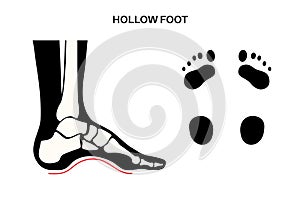 Hollow feet anatomy