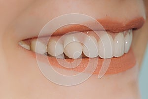 Hollywood smile with porcelain crowns and veneers