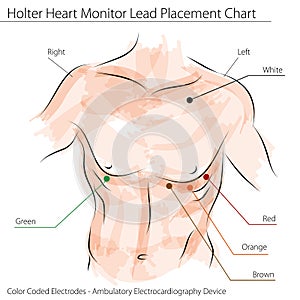 Holter Heart Monitor Lead Placement Chart photo