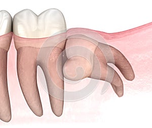 Horizontal impaction of Wisdom tooth. Medically accurate tooth 3D illustration