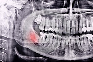 Horizontal inflamed wisdom tooth on Panoramic dental tooth X-ray examination