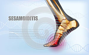 Horizontal sesamoiditis foot traumas banner