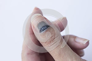 Horizontal shot of bruised thumb finger with hematoma.