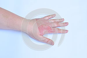 Horrible second degree burns on female hand on white background