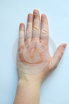 Horrible second degree burns on female hand on white background