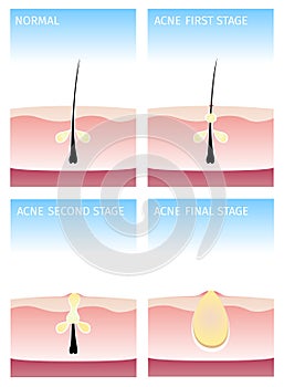 How acne happens. acne stages,