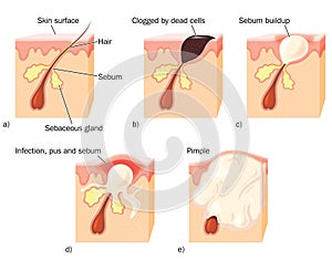 How a pimple develops