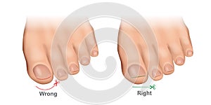 How to cut toenails correctly vector illustration. Proper and improper trimming of nails.Ingrown Toenails.