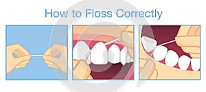 How to floss correctly for cleaning teeth